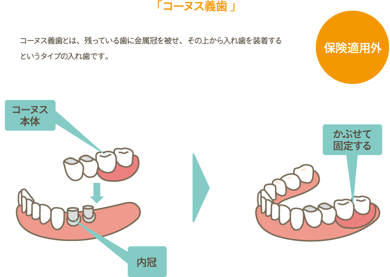 保険適用外 「コーヌス義歯」 コーヌス義歯とは、残っている歯に金属冠を被せ、その上から入れ歯を装着するというタイプの入れ歯です。
